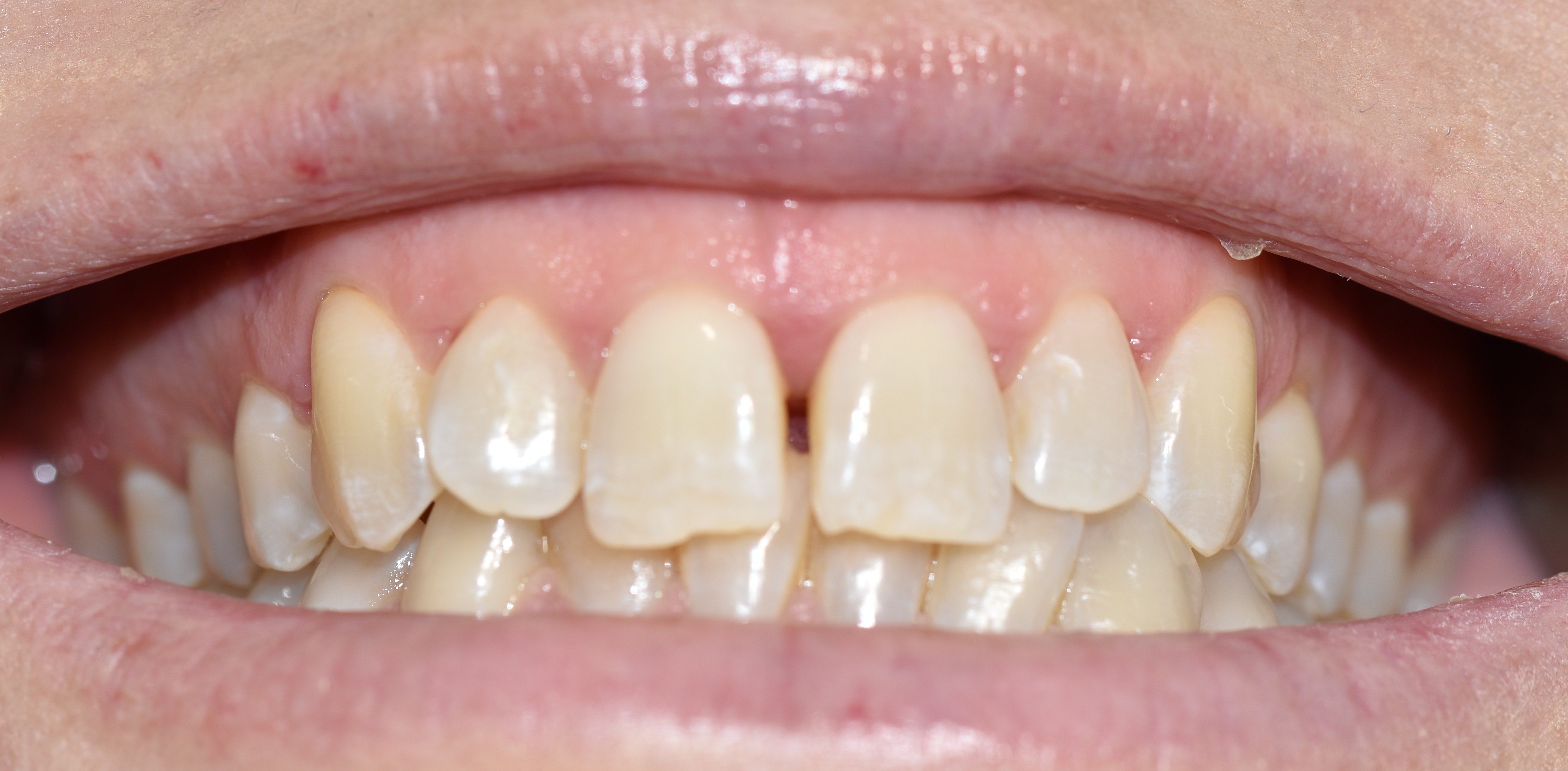 Before treatment